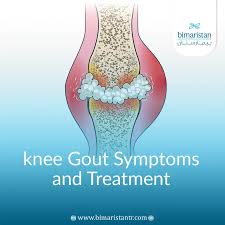 Image result for gout symptoms knee