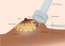 It can be difficult to know how your breast or scar area should feel, especially as the area can change over time as it repairs and heals. Know All About Breast Cancer Biopsy Onco Com