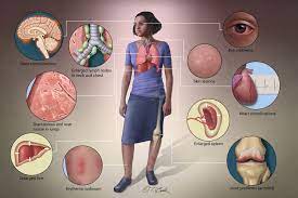 The decrease in other more severe symptoms is wheezing which if. 5 Myths You May Have Heard About Sarcoidosis Foundation For Sarcoidosis Research