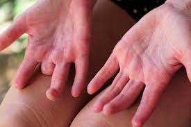 These can range in size from small specks to collections as large as tennis balls. Research Shows Cairns A Hotspot For Rare Skin Disease Scleroderma Abc News