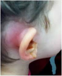 Image result for Mastoiditis