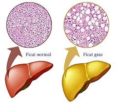 Ciroza hepatica este o afectiune ireversibila a ficatului, caracterizata prin distrugerea celulelor hepatice, pierderea elasticitatii tesuturilor si cu toate acestea, daca ciroza hepatica este diagnosticata mai devreme si cauza este tratata, daunele ulterioare pot fi limitate si, rareori, inversate. Steatoza Hepatica Ficatul Gras