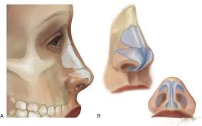It is a pyramidal structure, with its root located superiorly and apex sitting inferiorly. 38 Aesthetic Alteration Of The Nose Evaluation And Surgery Pocket Dentistry