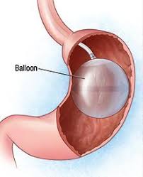 Gastric Balloon Abroad Avoiding Nhs Waiting Time