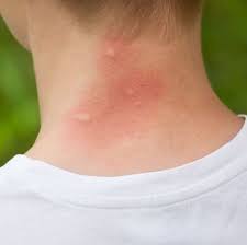 Skeeter syndrome or the mosquito bite allergy can be treated by using simple home remedies mentioned in this article. Mosquito Bite Allergy Symptoms Mosquito Bite Reaction Meaning