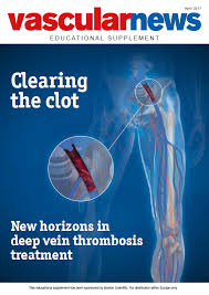 The most common site for dvt is in one of the veins deep within your legs. Clearing The Clot New Horizons In Deep Vein Thrombosis Treatment Venous News