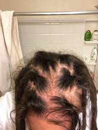Both men and women develop this type of hair loss, which is the most common cause of hair loss worldwide. Traction Alopecia Help Dreadlocks Forums Dreadlocks Natural Dreads