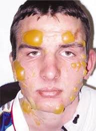 Sprejen smälte ansiktet