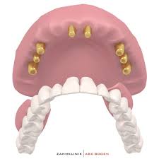 Getting a dental bridge is. Dental Bridges In Hamburg Germany Zahnklinik Abc Bogen