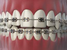 Fortunately, internet access in south africa has few restrictions, which means residents in south africa can access online content freely. Dental Braces Their Types And Costs