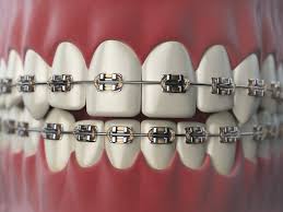 Yes, there're some ways to get orthodontic treatment (for you or your children) and don't declare for instance, there are many brands of clear orthodontic aligners that you can order right online. Dental Braces Their Types And Costs