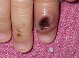 Monkeypox is a disease caused by a virus. Monkeypox Dermatology Advisor