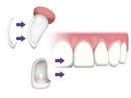 The flying dentist dentist veneer braces, first slow dentistry dentist asia. Veneer Gigi Rawatan Untuk Gigi Patah Pecah Jarang Dan Gigi Kuning