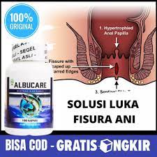 Penyebab fisura ani defekasi feses yang besar dan keras, trauma pada saat kelahiran, diare kronis, trauma akibat insersi pada anus, alergi makanan, kebiasaan menahan defekasi yang lama. Obat Fisura Ani Herbal Buat Penutup Luka Dekat Lubang Anus Dubur Susah Sembuh Obat Tradisional Untuk