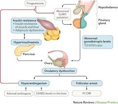Polycystic ovary syndrome (pcos) is a chronic endocrine disorder that affects women of reproductive age and is associated with infertility, hyperandrogenism, hirsutism, metabolic disorders. Polycystic Ovary Syndrome Nature Reviews Disease Primers
