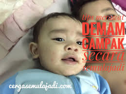 Cara ini adalah cara yang paling mudah untuk menghilangkan komedo dari wajah. Merawat Chickenpox Baby Secara Semula Jadi Sihat Dan Cergas Semulajadi