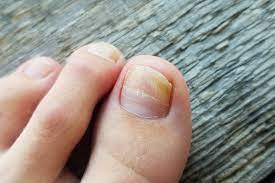 Белое пятно на ногте большого пальца ноги