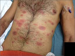 Image result for Generalized Rash