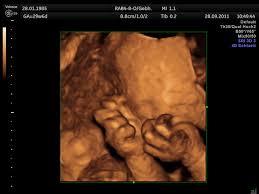 Ist ultraschall in der schwangerschaft gefährlich? 3d 4d Ultraschall Dr Med Leoni Hafner