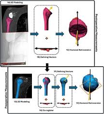 Anatomic restoration of lateral humeral offset and humeral retroversion  optimizes functional outcomes following reverse total shoulder arthroplasty 