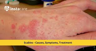 Image result for scabies symptoms