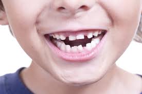 Teaching Your Kids About Gingivitis Smile Surfers Kids Dentistry