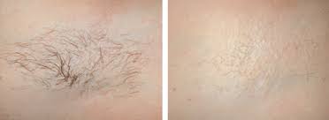 This energy passes through the uppermost layer of the skin. Laser Hair Removal Seattle Dermatology Permanently Get Rid Of Hair