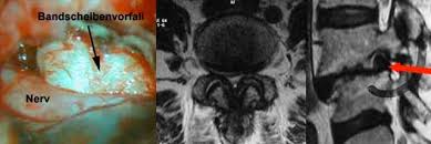 Hier finden sie alle informationen über den bandscheibenvorfall. Prof Dr Christian Woiciechowsky Neurochirurgie Berlin Mikrochirurgische Bandscheibenoperation