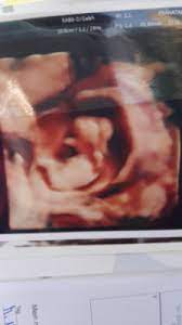 Wan Erfahrt Man Das Geschlecht Vom Baby Februar 2017 Babyclub Babycenter