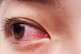 Red Bloodshot Eyes A Cause For Concern
