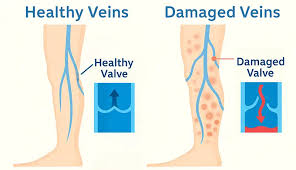 Image result for Stasis Dermatitis