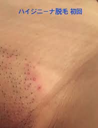 ハイジニーナ 画像