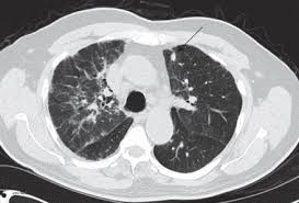 Image result for XRay Changes in Rheumatic Conditions