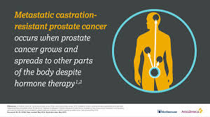 It's also called metastatic prostate cancer. Astrazeneca On Twitter Up To 20 Of Men With Advanced Prostatecancer May Develop Castration Resistant Prostate Cancer Within 5 Years Of Follow Up Research Continues To Work Towards Advancing Treatment Options For These Patients