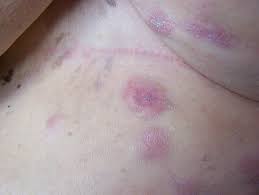 Cancer recurrence or progression presents a somewhat different set of challenges for health professionals. Unique Skin Metastasis From Recurrent Cancer Case Report Ccid