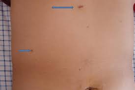 The gastric bypass operation is performed laparoscopically and results in reduced pain and better and smaller scars. Scarring And Weight Loss Surgery Lifetime Surgical
