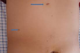 The gastric bypass operation is performed laparoscopically and results in reduced pain and better and smaller scars. Scarring And Weight Loss Surgery Lifetime Surgical