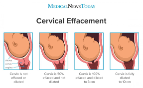 What To Know About Cervical Effacement Measurements And Diagram
