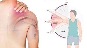 Image result for Frozen Shoulder