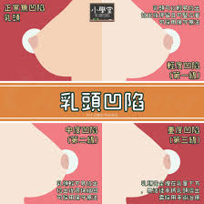 小學堂】乳頭凹陷| 林才民整形外科診所CIARS