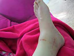 Some ankle fractures may require surgery when when surgery is needed, it may require metal pins, screws, or plates to hold the bones in place as the fracture heals. Broken Ankle Recovery Learning To Walk Again Lynda Makara