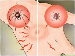 Black widow spider bite everyone knows what a black widow looks like, with its distinctive red hourglass on its abdomen. How To Identify A Spider Bite 7 Steps With Pictures Wikihow