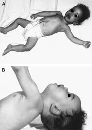 Image result for Floppy Infant