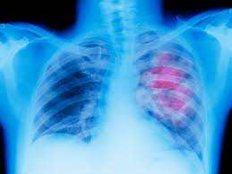 Image result for lung cancer xray