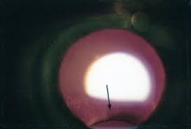 Image result for Coloboma