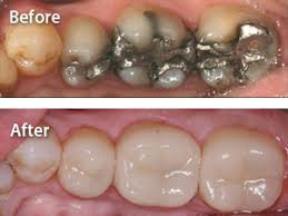 Carson City Dentists At Advanced Dentistry By Design Can Design Fabricate And Place Dental Restorations In Dentistry Restorative Dentistry Dental Restoration