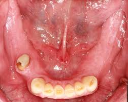 Image result for Gag Reflex