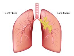 What is the vector of malaria? Lung Cancer Symptoms Causes Treatment And Survival Rates