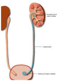 Ureteric Stent Going Home Milton Keynes University Hospital