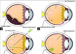 Retinal detachments may initially be localised, but without treatment. Schematic Representation Of The Surgical Technique Of Glue Assisted Download Scientific Diagram